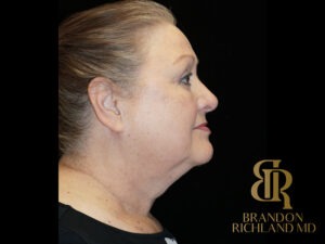 Blepharoplasty before and after, Patient 01 — Dr. Brandon Richland, Newport Beach