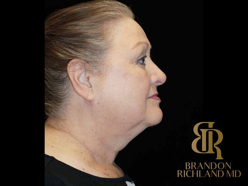 Blepharoplasty After, Patient 01, view 3 — Dr. Brandon Richland, Newport Beach