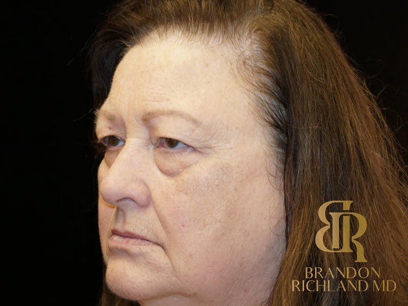 Blepharoplasty Before, Patient 01, view 4 — Dr. Brandon Richland, Newport Beach