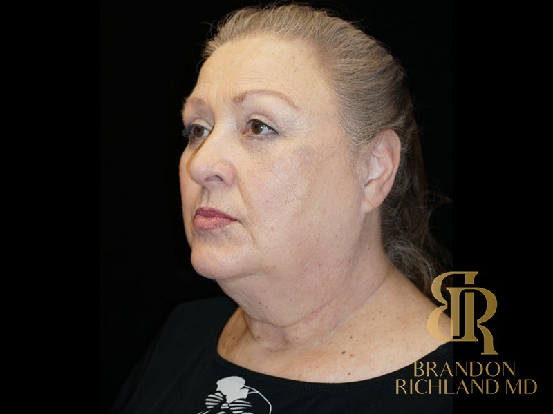 Blepharoplasty After, Patient 01, view 4 — Dr. Brandon Richland, Newport Beach