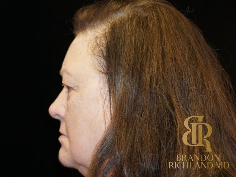 Blepharoplasty Before, Patient 01, view 5 — Dr. Brandon Richland, Newport Beach
