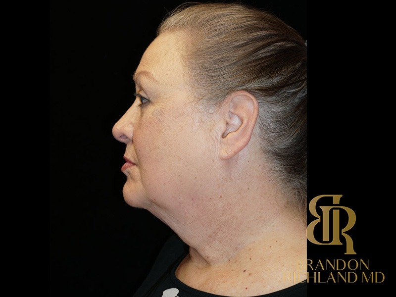 Blepharoplasty After, Patient 01, view 5 — Dr. Brandon Richland, Newport Beach