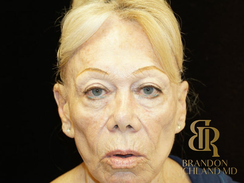 Blepharoplasty Before, Patient 02, view 2 — Dr. Brandon Richland, Newport Beach