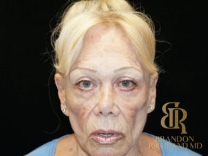 Blepharoplasty before and after, Patient 02 — Dr. Brandon Richland, Newport Beach