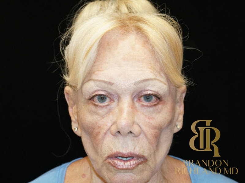 Blepharoplasty After, Patient 02, view 2 — Dr. Brandon Richland, Newport Beach