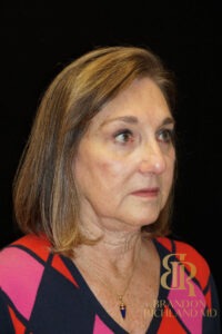 Blepharoplasty before and after, Patient 03 — Dr. Brandon Richland, Newport Beach