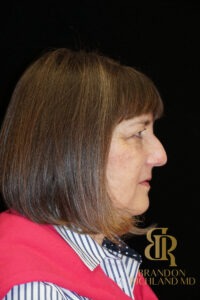 Blepharoplasty before and after, Patient 03 — Dr. Brandon Richland, Newport Beach