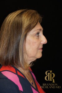 Blepharoplasty before and after, Patient 03 — Dr. Brandon Richland, Newport Beach