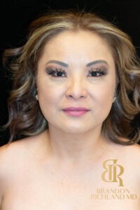 Blepharoplasty before and after, Patient 04 — Dr. Brandon Richland, Newport Beach