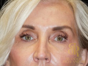 Blepharoplasty before and after, Patient 06 — Dr. Brandon Richland, Newport Beach