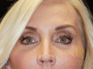 Blepharoplasty before and after, Patient 06 — Dr. Brandon Richland, Newport Beach