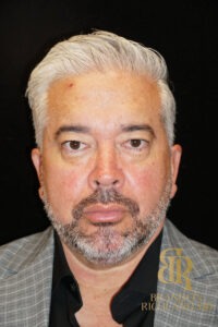 Blepharoplasty before and after, Patient 07 — Dr. Brandon Richland, Newport Beach