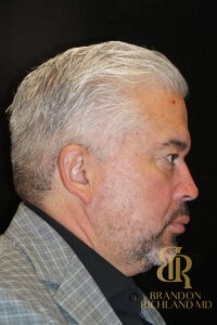 Blepharoplasty before and after, Patient 07 — Dr. Brandon Richland, Newport Beach