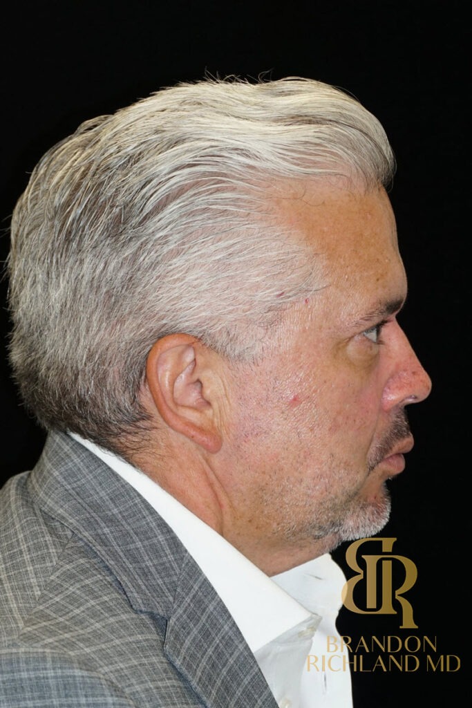 Blepharoplasty After, Patient 07, view 3 — Dr. Brandon Richland, Newport Beach