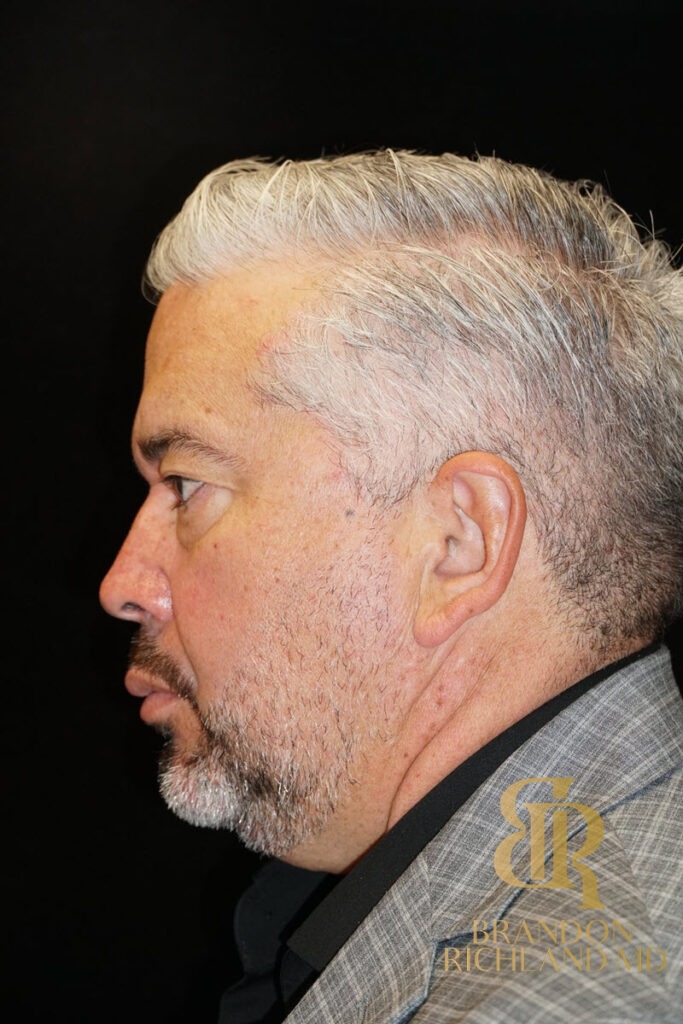 Blepharoplasty Before, Patient 07, view 5 — Dr. Brandon Richland, Newport Beach