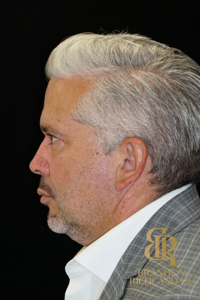 Blepharoplasty After, Patient 07, view 5 — Dr. Brandon Richland, Newport Beach