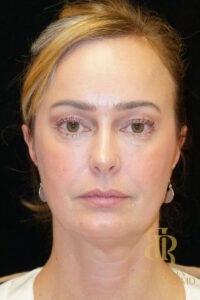 Blepharoplasty before and after, Patient 08 — Dr. Brandon Richland, Newport Beach