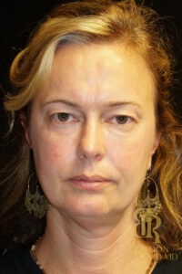 Blepharoplasty before and after, Patient 08 — Dr. Brandon Richland, Newport Beach