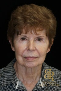 Blepharoplasty before and after, Patient 09 — Dr. Brandon Richland, Newport Beach