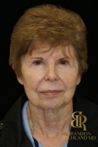 Blepharoplasty before and after, Patient 09 — Dr. Brandon Richland, Newport Beach