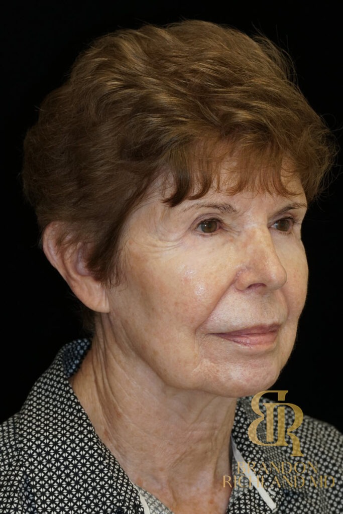 Blepharoplasty Before, Patient 09, view 2 — Dr. Brandon Richland, Newport Beach