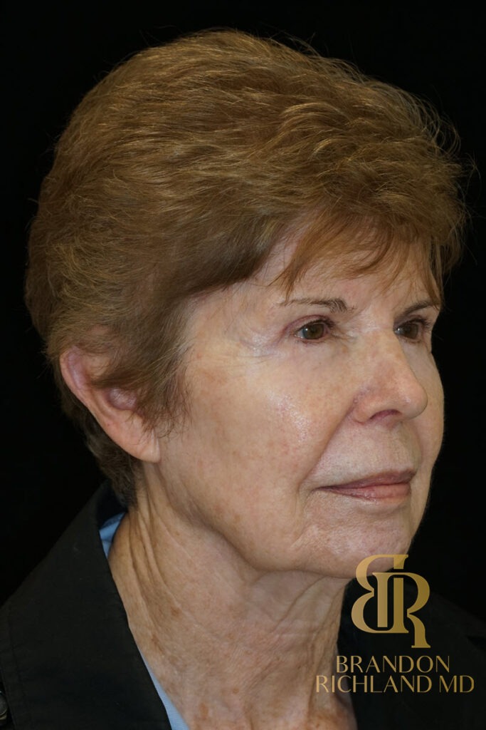 Blepharoplasty After, Patient 09, view 2 — Dr. Brandon Richland, Newport Beach