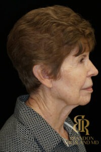 Blepharoplasty before and after, Patient 09 — Dr. Brandon Richland, Newport Beach