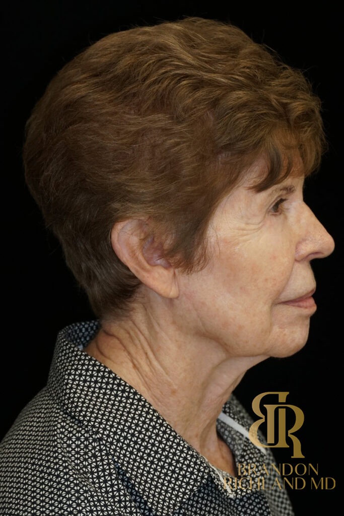 Blepharoplasty Before, Patient 09, view 3 — Dr. Brandon Richland, Newport Beach