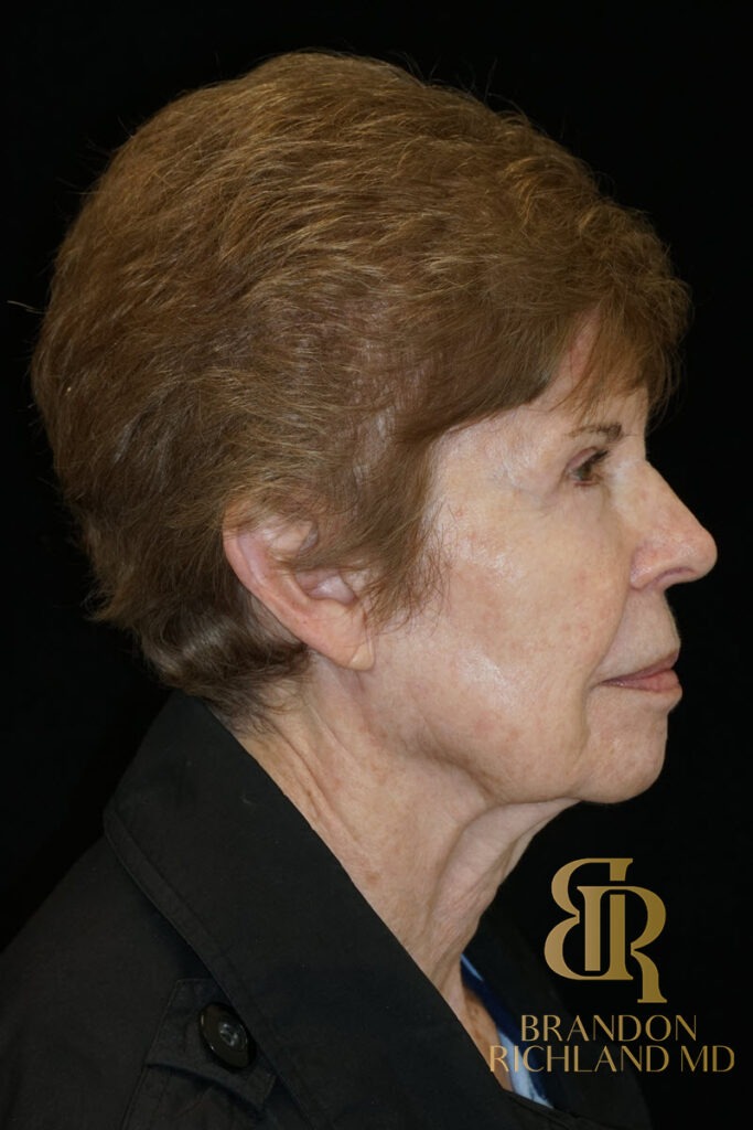 Blepharoplasty After, Patient 09, view 3 — Dr. Brandon Richland, Newport Beach