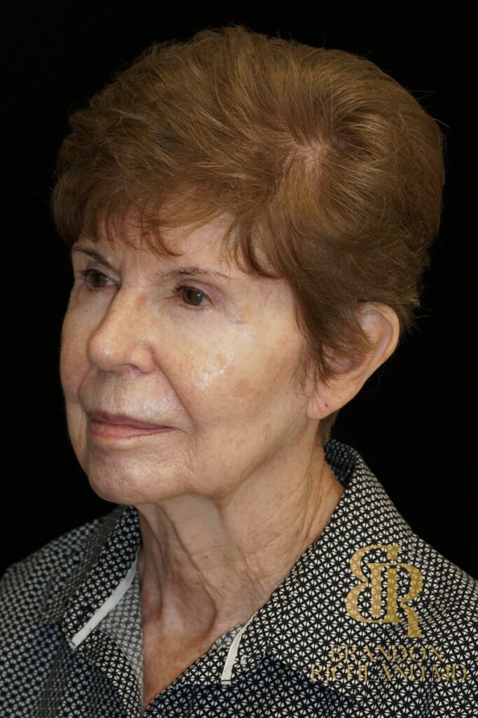Blepharoplasty Before, Patient 09, view 4 — Dr. Brandon Richland, Newport Beach