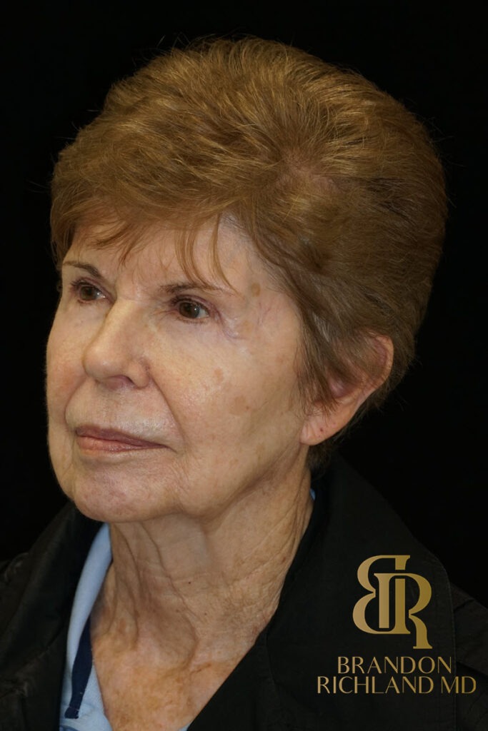 Blepharoplasty After, Patient 09, view 4 — Dr. Brandon Richland, Newport Beach