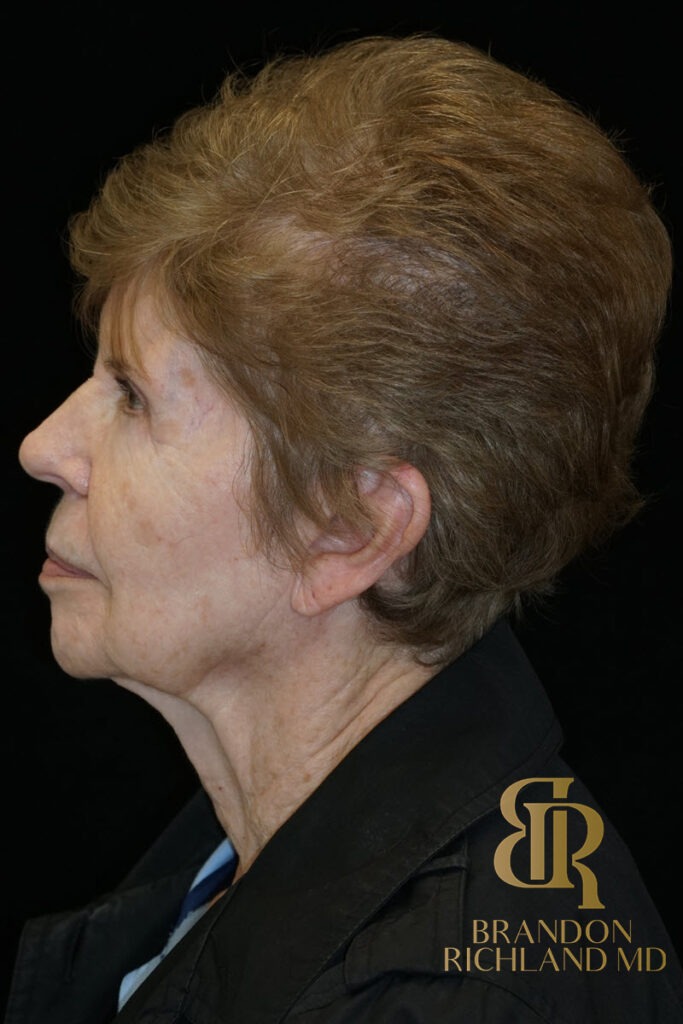 Blepharoplasty After, Patient 09, view 5 — Dr. Brandon Richland, Newport Beach