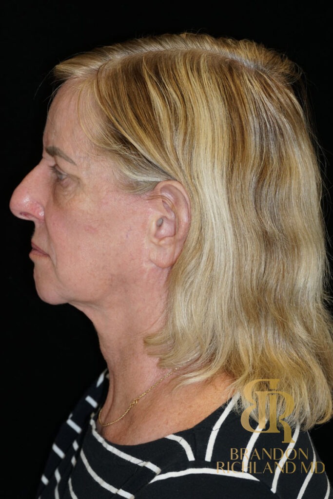 Blepharoplasty Before, Patient 10, view 5 — Dr. Brandon Richland, Newport Beach