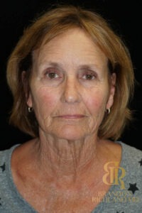 Blepharoplasty before and after, Patient 11 — Dr. Brandon Richland, Newport Beach