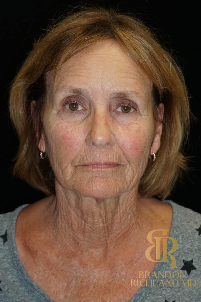 Blepharoplasty Before, Patient 11, view 1 — Dr. Brandon Richland, Newport Beach