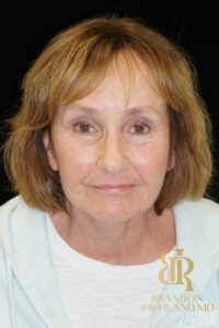 Blepharoplasty before and after, Patient 11 — Dr. Brandon Richland, Newport Beach