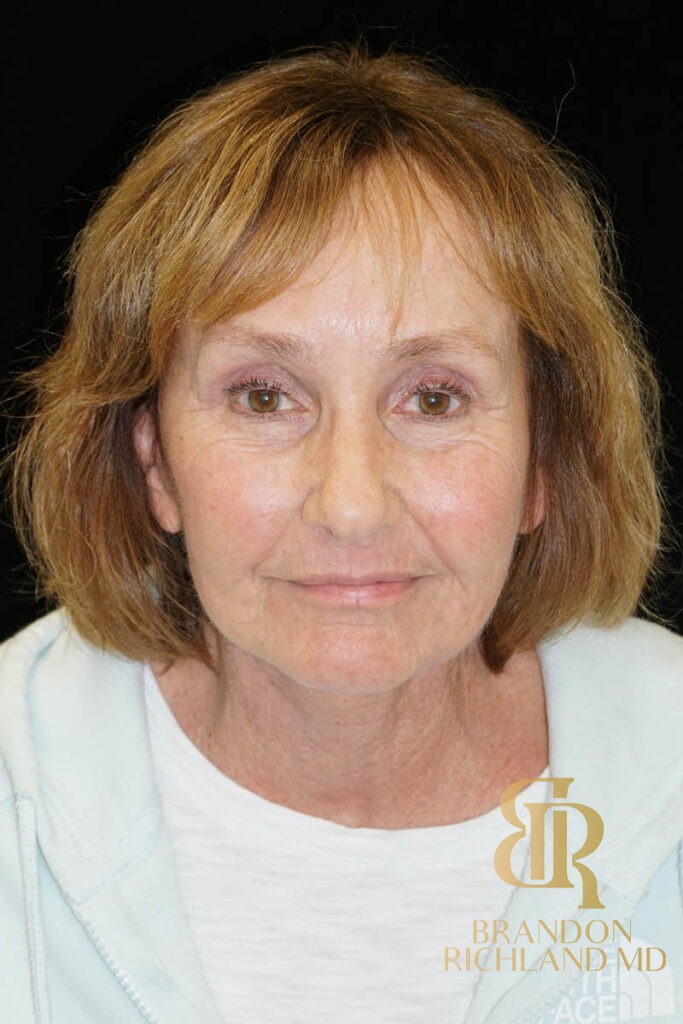 Blepharoplasty After, Patient 11, view 1 — Dr. Brandon Richland, Newport Beach
