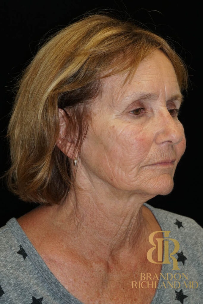 Blepharoplasty Before, Patient 11, view 2 — Dr. Brandon Richland, Newport Beach