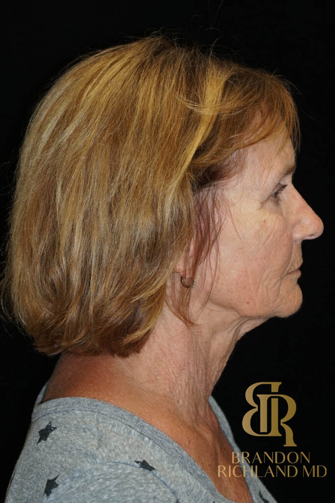 Blepharoplasty Before, Patient 11, view 3 — Dr. Brandon Richland, Newport Beach