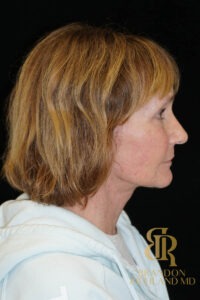 Blepharoplasty before and after, Patient 11 — Dr. Brandon Richland, Newport Beach