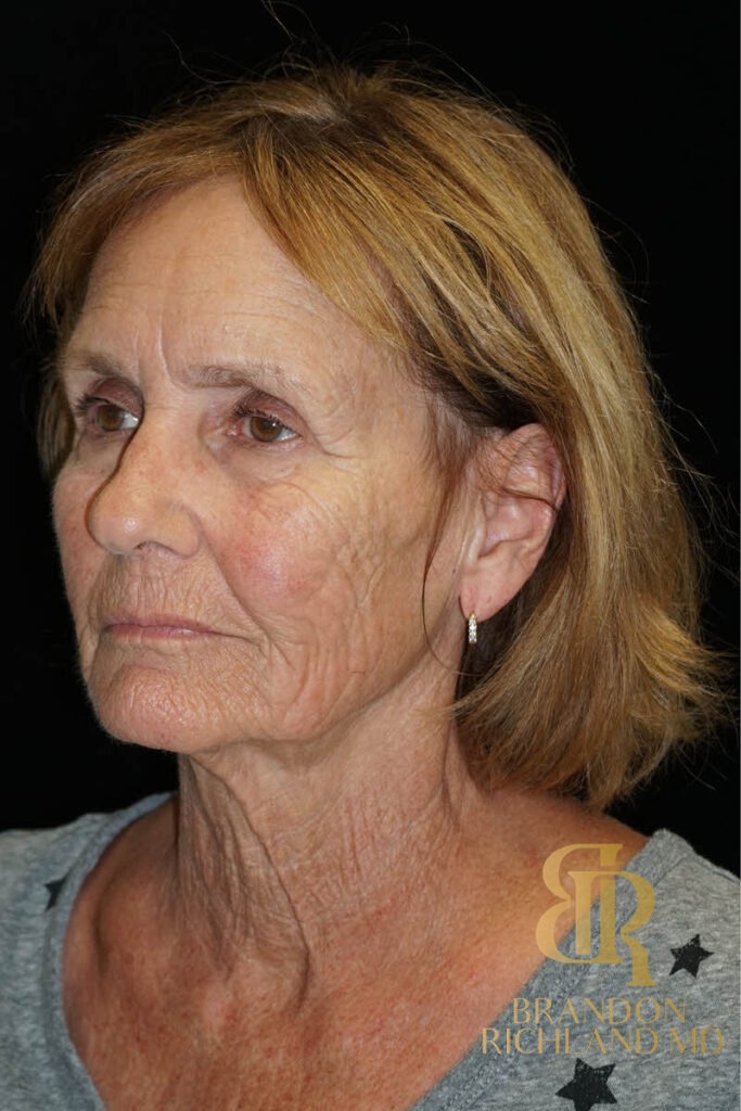 Blepharoplasty Before, Patient 11, view 4 — Dr. Brandon Richland, Newport Beach