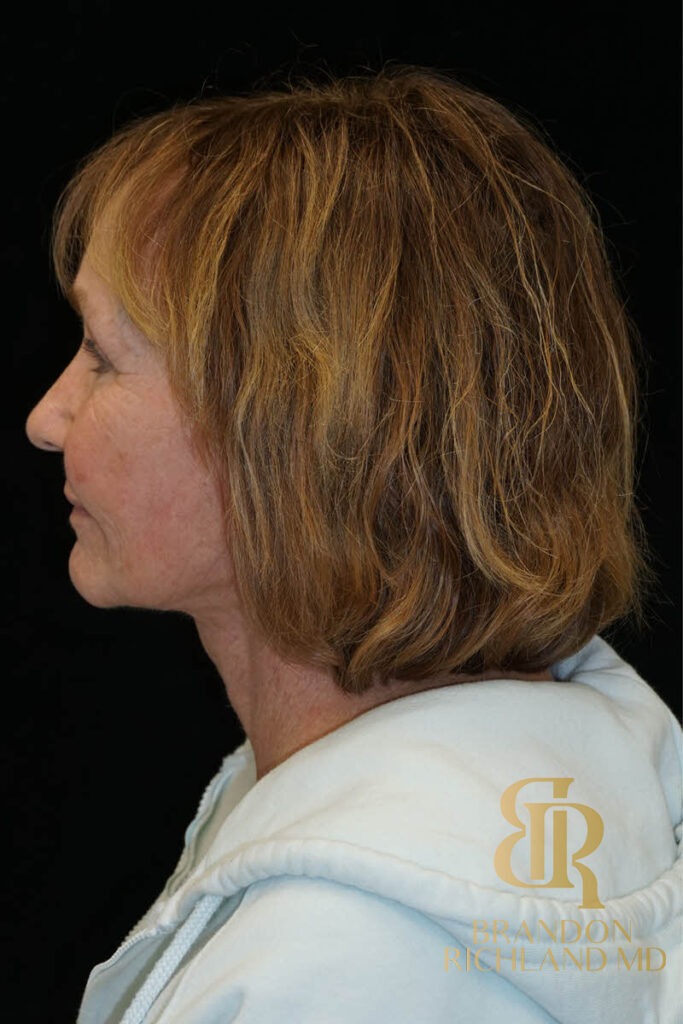 Blepharoplasty After, Patient 11, view 5 — Dr. Brandon Richland, Newport Beach