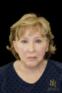 Brow Lift before and after, Case #11800 — Dr. Brandon Richland, Newport Beach