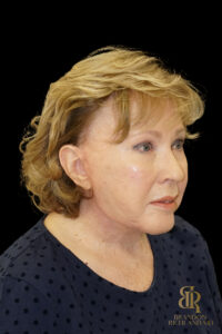 Brow Lift before and after, Case #11800 — Dr. Brandon Richland, Newport Beach