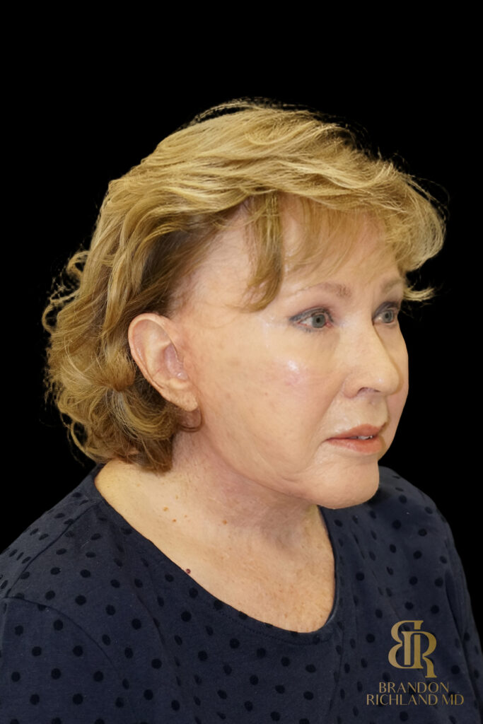 Brow Lift After, Case #11800, view 2 — Dr. Brandon Richland, Newport Beach