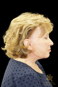 Brow Lift before and after, Case #11800 — Dr. Brandon Richland, Newport Beach