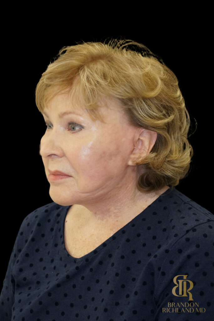 Brow Lift After, Case #11800, view 5 — Dr. Brandon Richland, Newport Beach