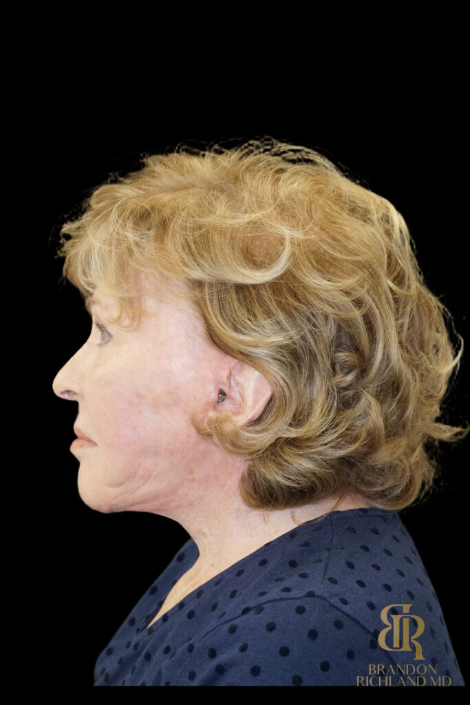 Brow Lift After, Case #11800, view 6 — Dr. Brandon Richland, Newport Beach
