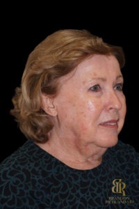 Brow Lift before and after, Case #11800 — Dr. Brandon Richland, Newport Beach