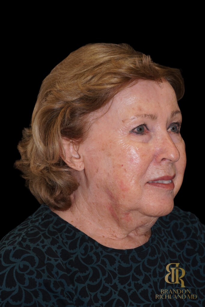 Brow Lift Before, Case #11800, view 2 — Dr. Brandon Richland, Newport Beach